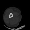SPORK, NICO - 22.03.1976 - 02.08.2022 - CT obere Extremität - 17:51:17